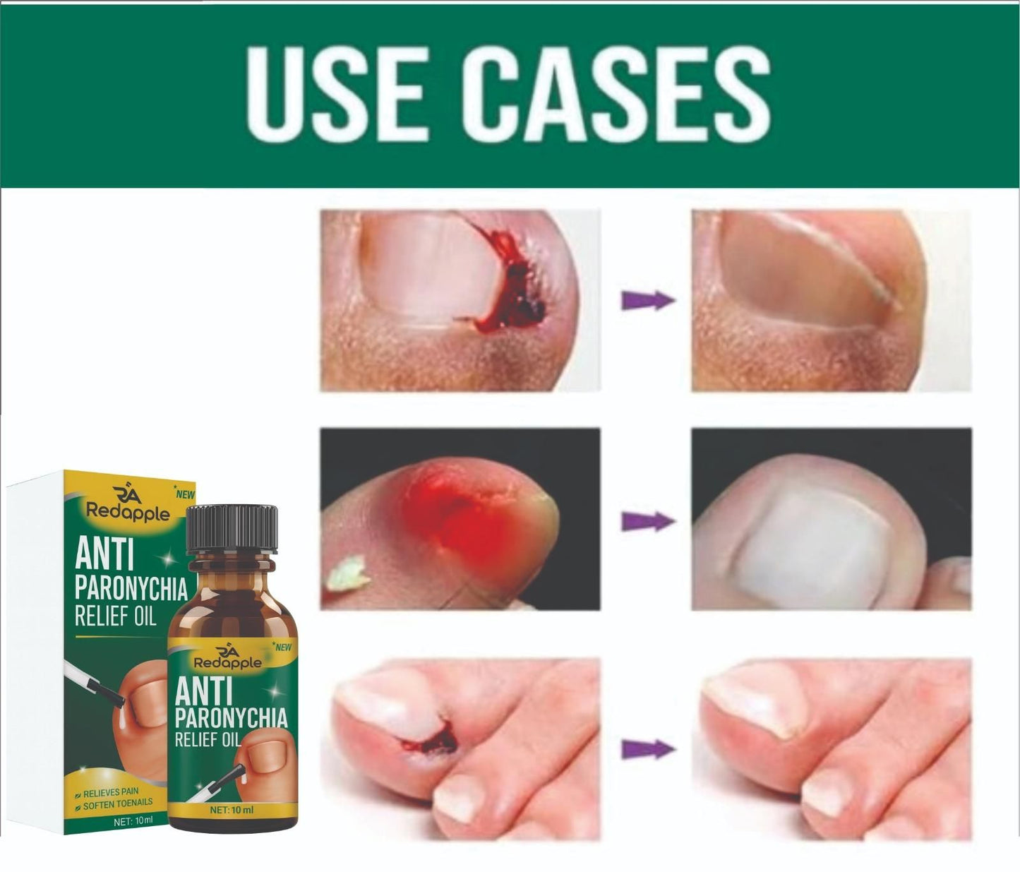 Nail Fungus Anti Paronychia Relief Oil 20 ml (Pack of 2) BUY 1 GET 1 FREE! FLAT Rs. 100 OFF on UPI Payments!