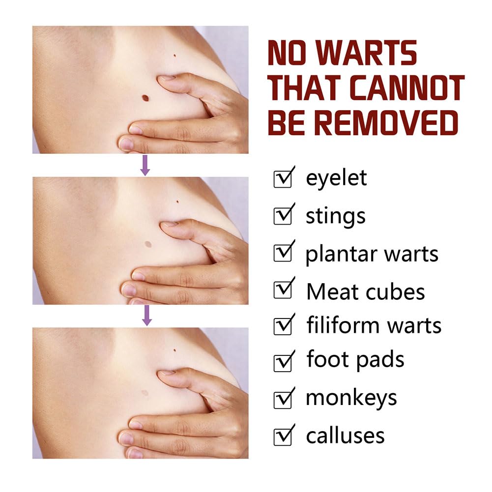 Professional Skin Tag & Mole Removal Device – Flawless Skin At Home - Vistora