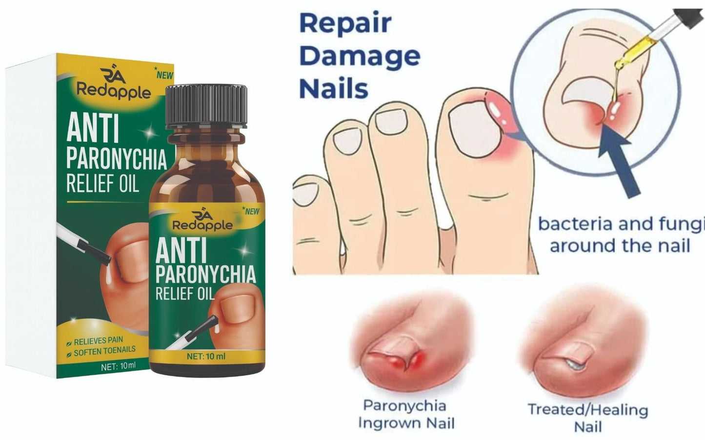 Nail Fungus Anti Paronychia Relief Oil 20 ml (Pack of 2) BUY 1 GET 1 FREE! FLAT Rs. 100 OFF on UPI Payments!