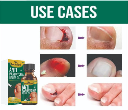 Nail Fungus Anti Paronychia Relief Oil 20 ml (Pack of 2) BUY 1 GET 1 FREE! FLAT Rs. 100 OFF on UPI Payments!